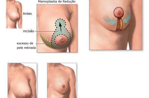 mamoplastia.redutora.imagem