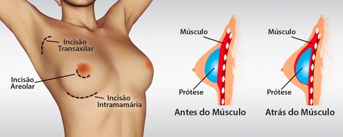 mamoplastia.aumento.imagem