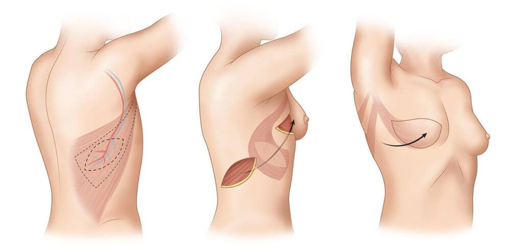 Mamoplastia Reconstrutiva.imagem